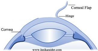 LASIK Corneal Flap & Hinge